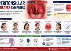 Peritonsillar Abscess Symptoms: Early Signs, Treatment, and Recovery